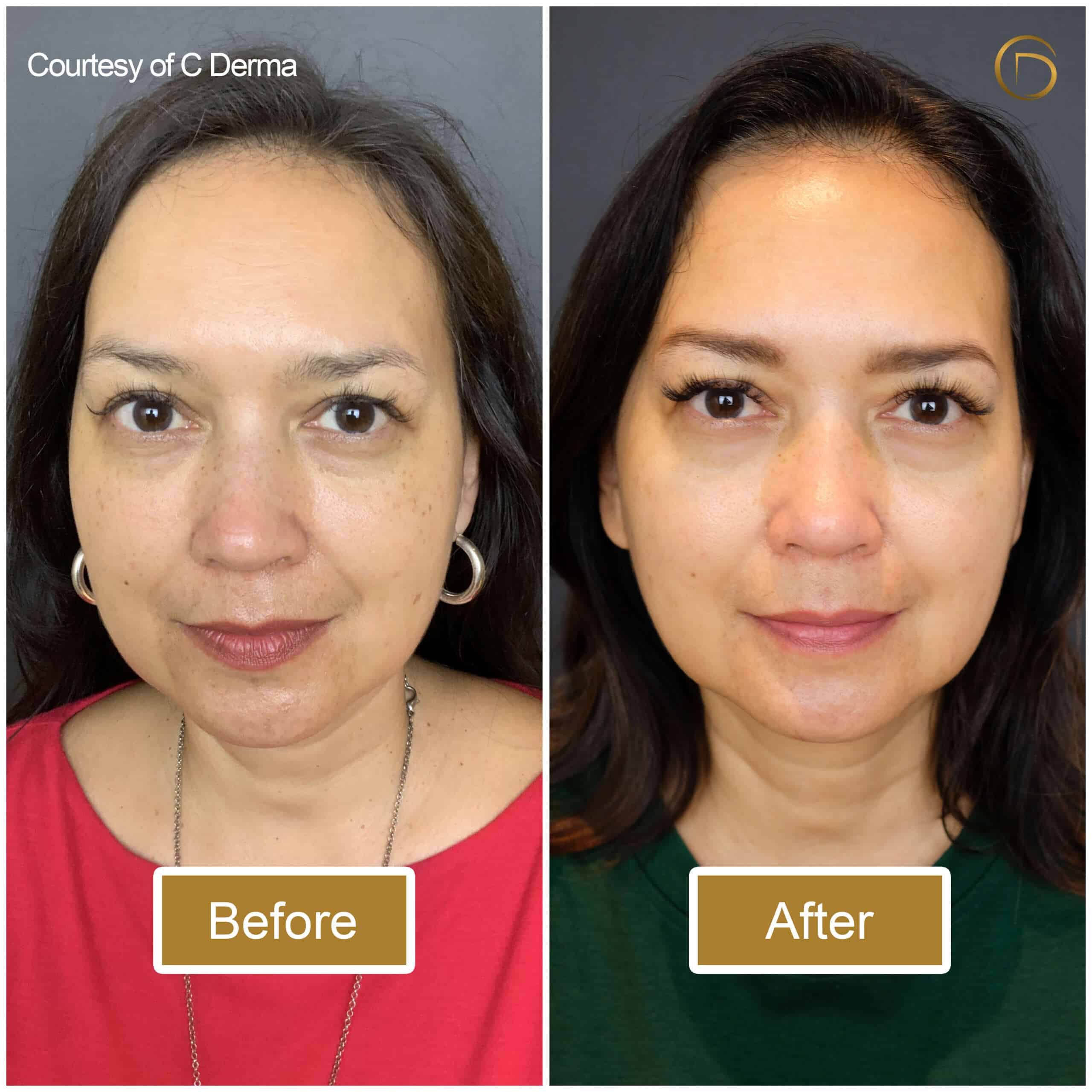 Ira Wibowo - Before After Ultherapy Ira Wibowo - Before After Ultherapy