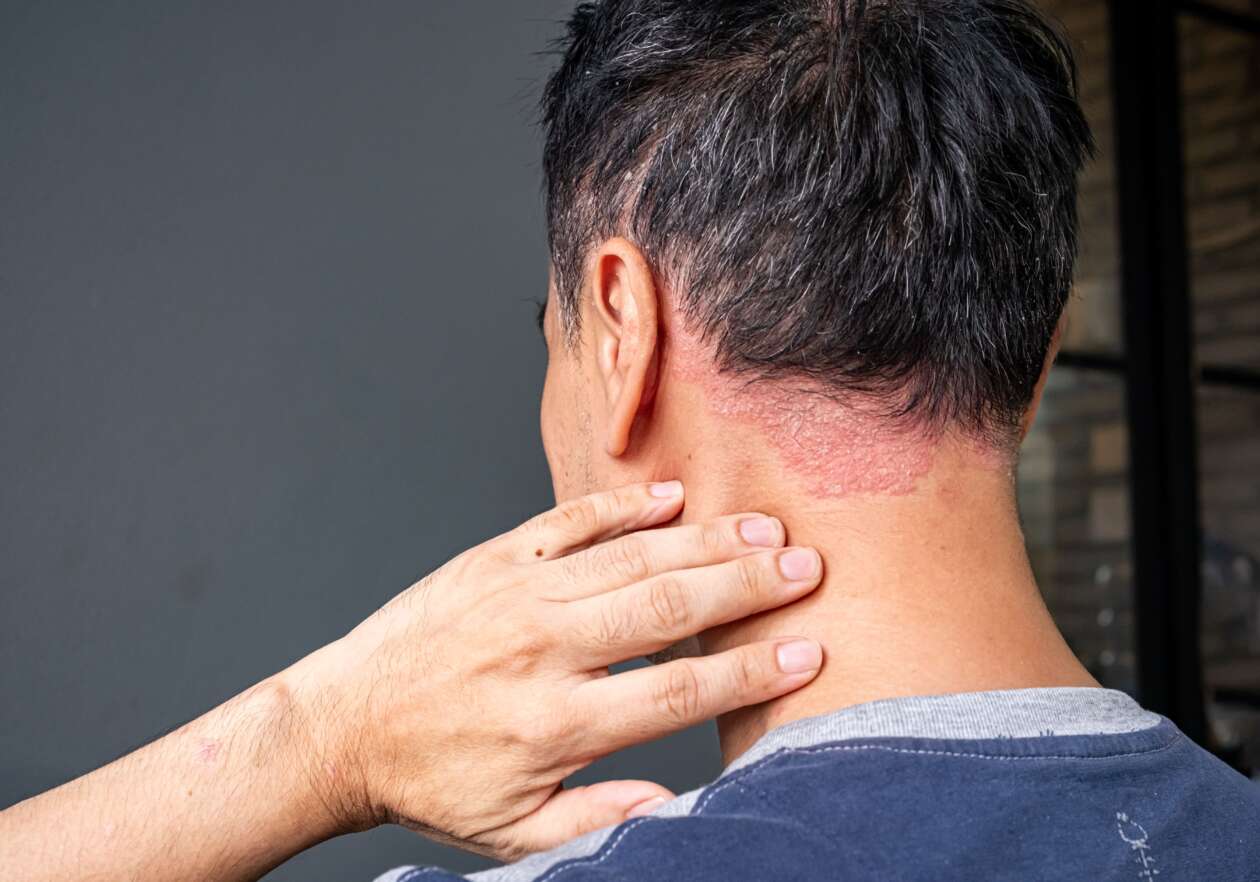 Psoriasis adalah