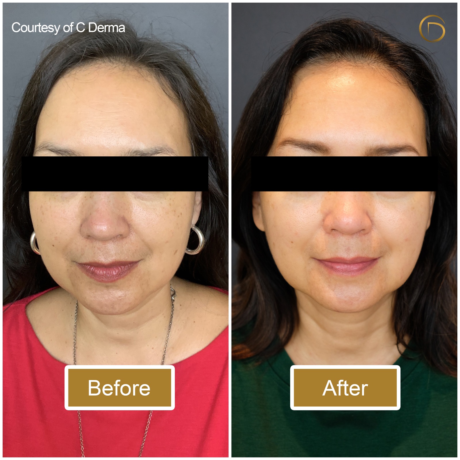 ultherapy jakarta