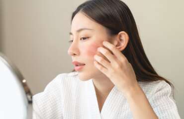 Macam-Macam Dermatitis, Gejala dan Cara Mengatasinya