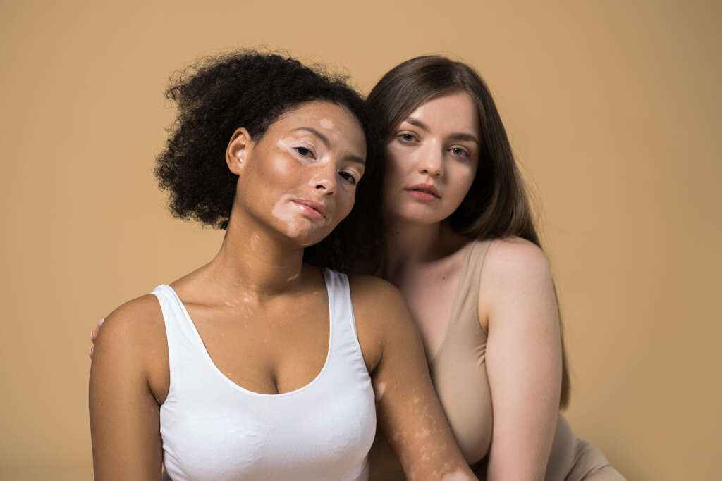 ilustrasi perawatan vitiligo di jakarta