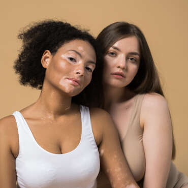 Mengenal Perawatan Vitiligo di Klinik C Derma Jakarta