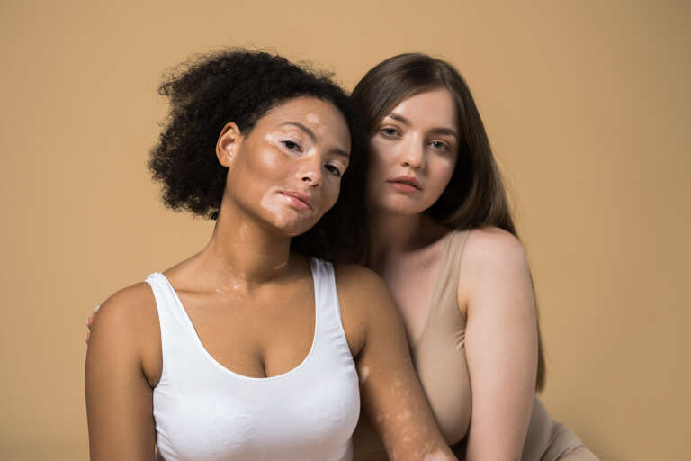 Mengenal Perawatan Vitiligo di  Klinik C Derma Jakarta