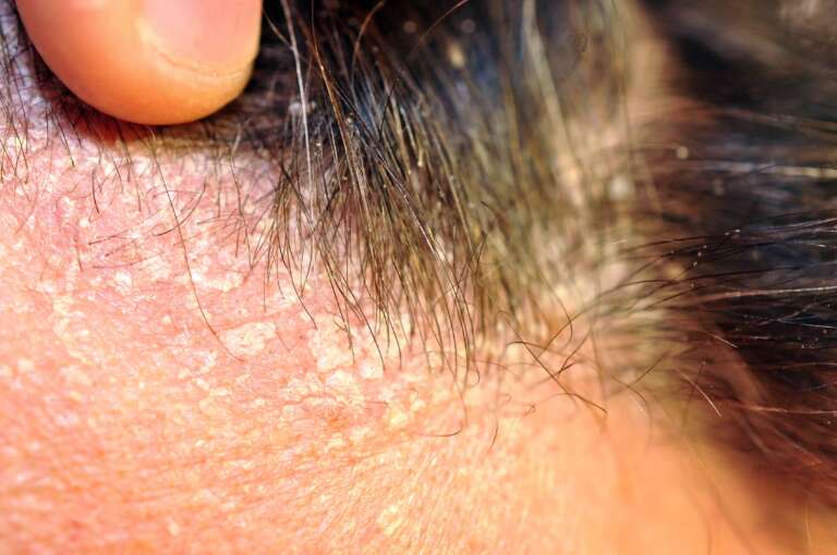 Mengenal Dermatitis Seboroik dan Pengobatan yang Tepat